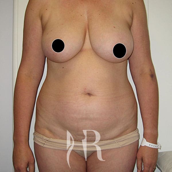 HR Plastic Surgery - Breast Reconstruction patient before 4